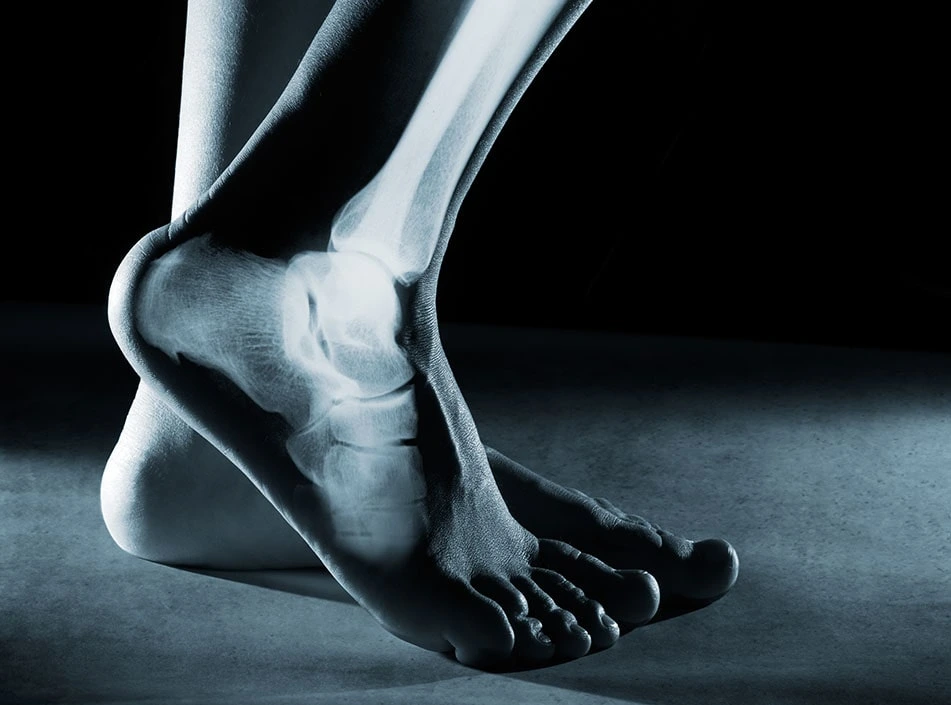 Ankle Osteoarthritis